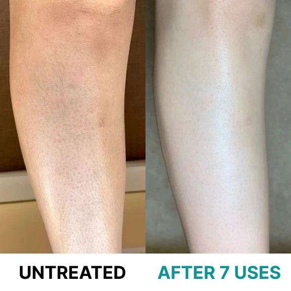 Multi-Acid Resurfacing Cream for Keratosis Pilaris