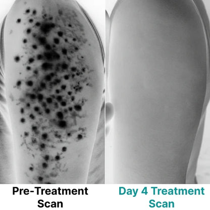 Multi-Acid Resurfacing Cream for Keratosis Pilaris