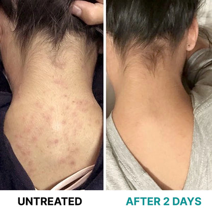 Multi-Acid Resurfacing Cream for Keratosis Pilaris