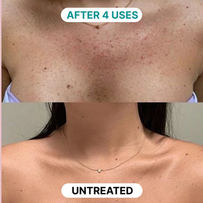 Multi-Acid Resurfacing Cream for Keratosis Pilaris